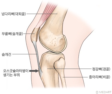 오스굿슐라터병의 발생 부위