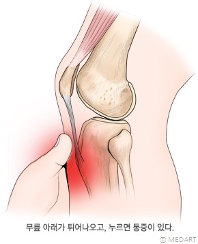 오스굿슐라터병의 증상