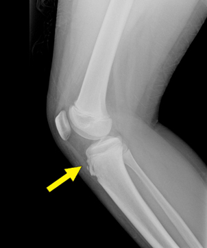 오른쪽 무릎에 나타난 오스굿슐라터병의 단순방사선촬영