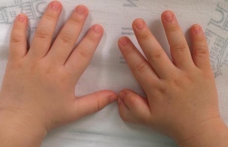 오른쪽 엄지손가락에 발생한 다지증