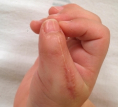 다지증의 수술적 치료 결과