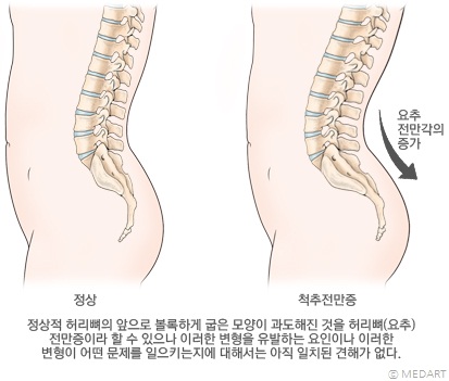 척추전만증