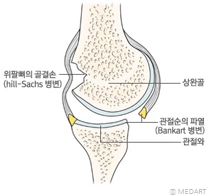 어깨 관절 탈구시 발생할 수 있는 관절순 파열(Bankart 병변) 및 골격손 파열(Hill-Sachs 병변)