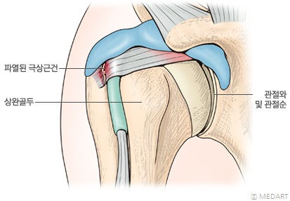 어깨 관절 탈구시 발생할 수 있는 어깨돌림근띠(회전근개) 파열