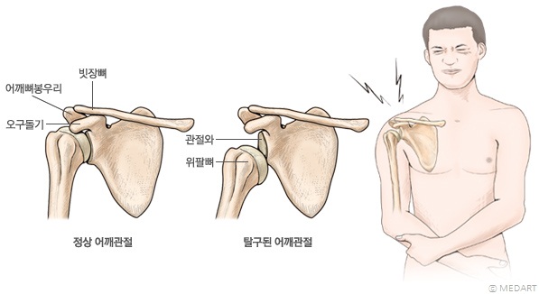 어깨 관절의 탈구 및 탈구 시의 증상