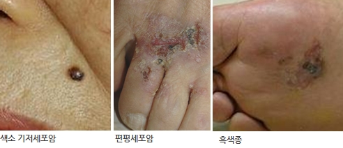 피부암의 여러 증상