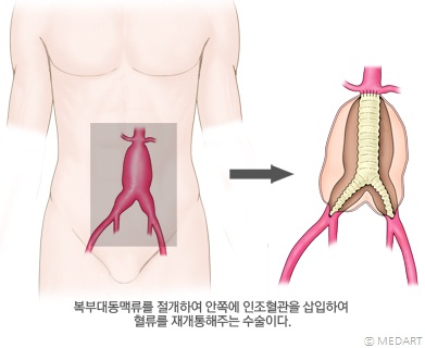 개복에 의한 인조혈관 치환술