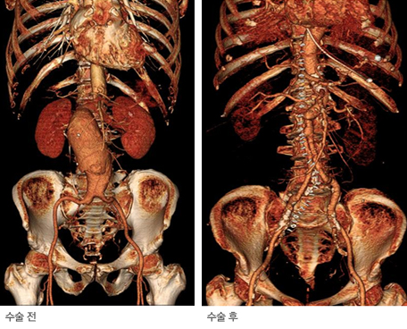 복부대동맥류 수술 전후 CT 3D 영상