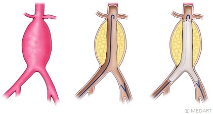 스텐트결합 인조혈관 삽입 과정