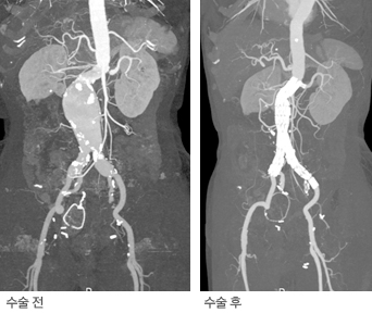스텐트결합 인조혈관 삽입술