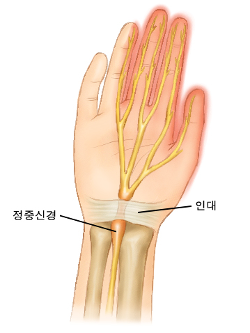 손목굴 증후군에서 통증이 나타나는 부위