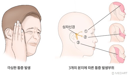 삼차신경통