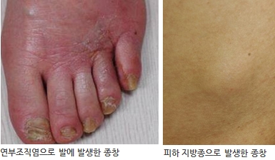종창 병변 사진
