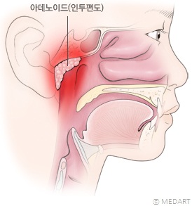 아데노이드 비대증