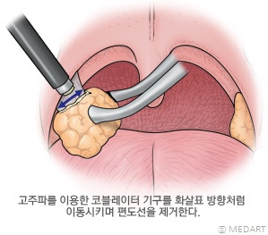 편도 절제술