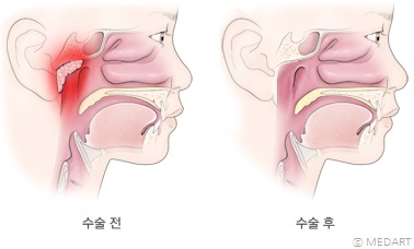 아데노이드 절제술