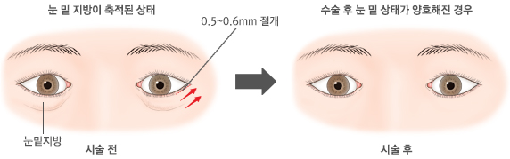 눈밑지방 제거 시술 전과 후