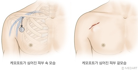 케모포토가 피부 밑에 심어진 모습 