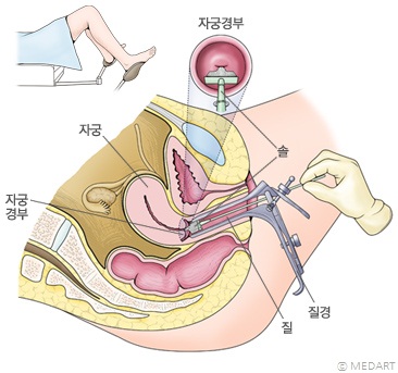 자궁경부암 검사 모식도