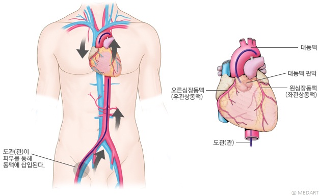 관상동맥조영술 모식도