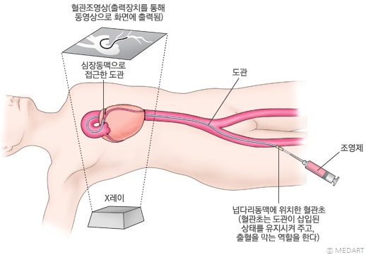 관상동맥조영술의 방법