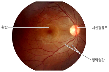 정상 안저 사진