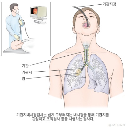 기관지 내시경 검사 모식도