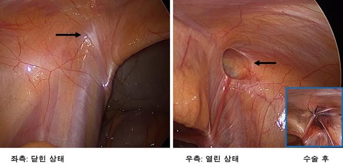 복강경 탈장 교정술