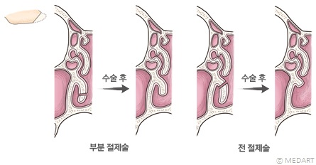 하비갑개 절제술