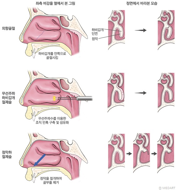 하비갑개 각종 수술