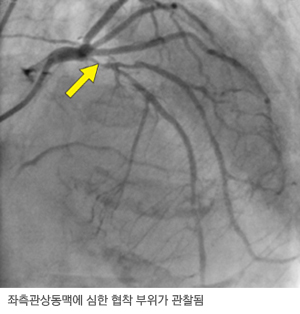 관상동맥 조영술 영상