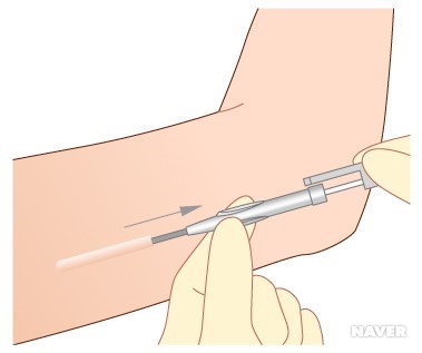 임플라논 시술 방법