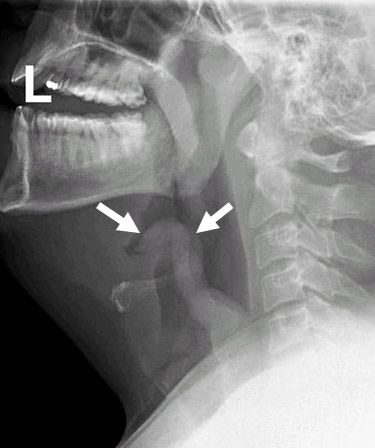 급성 후두개염의 x-ray
