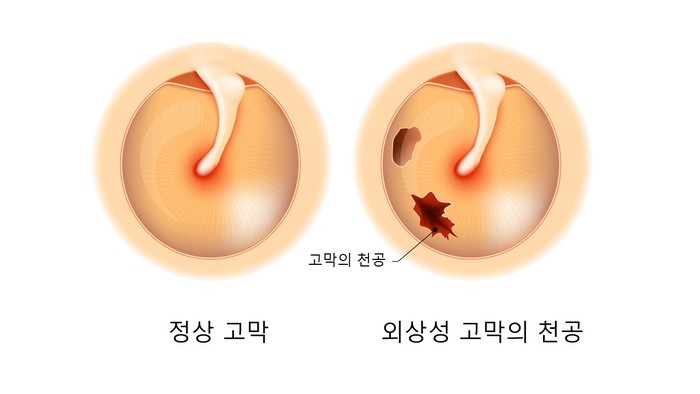 외상성 고막 천공