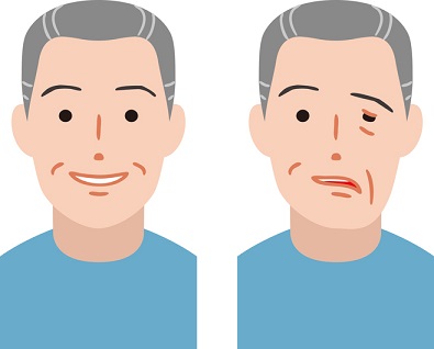 안면 신경마비