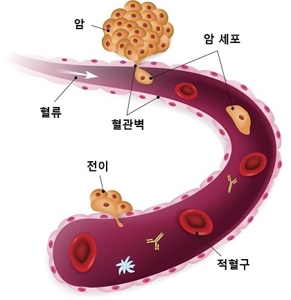 악성종양