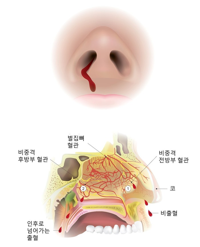 비출혈