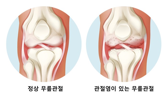 관절염이 있는 무릎