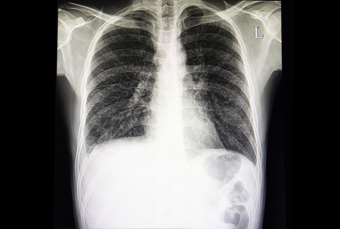 Drot Radiography 서울대학교병원
