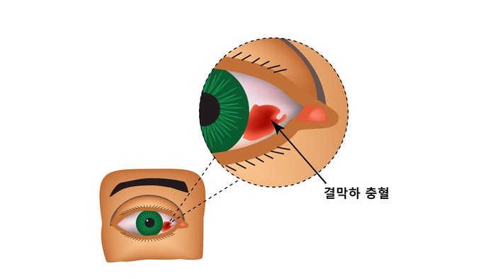 결막하 출혈