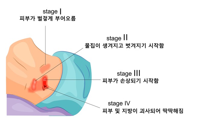 욕창의 발생