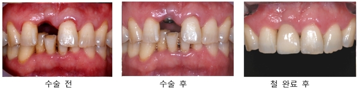 부분 치아 임플란트