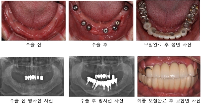 전체 치아 임플란트