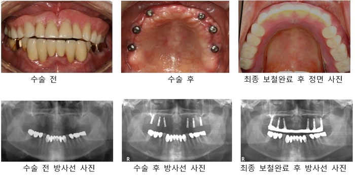 틀니용 임플란트
