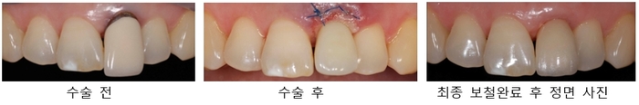 발치 후 즉시 임플란트