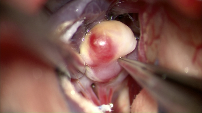 노출된 뇌동맥류