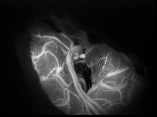 인도시아닌 형광 혈관 조영술