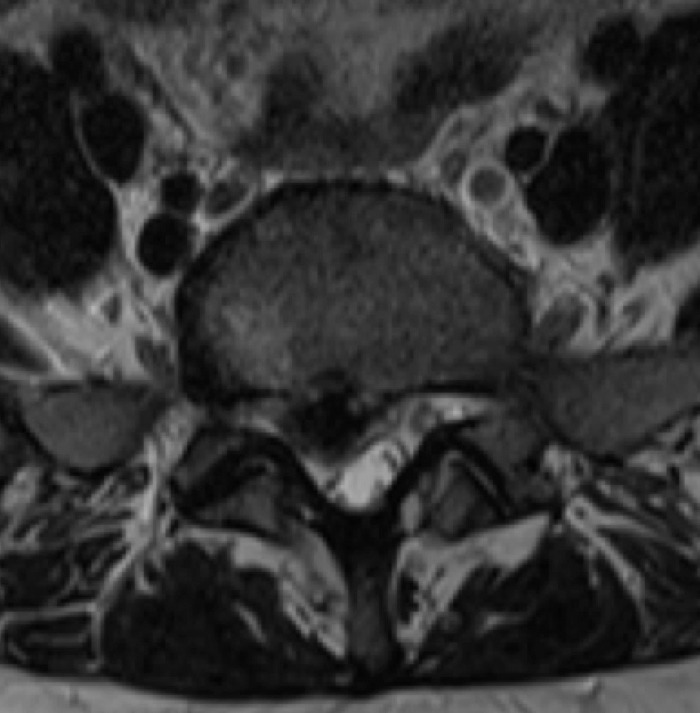 추간판 탈출증 MRI(2)