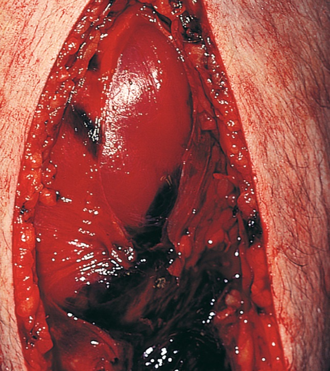 구획 증후군으로 진행하여 근막절개술을 한 모습