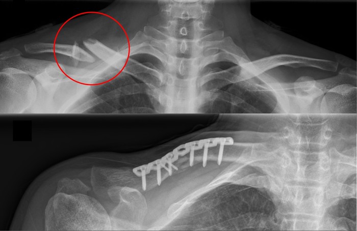 (위) 쇄골 골절의 x-ray 소견 (아래) 수술 (금속판 고정술) 이후의 모습